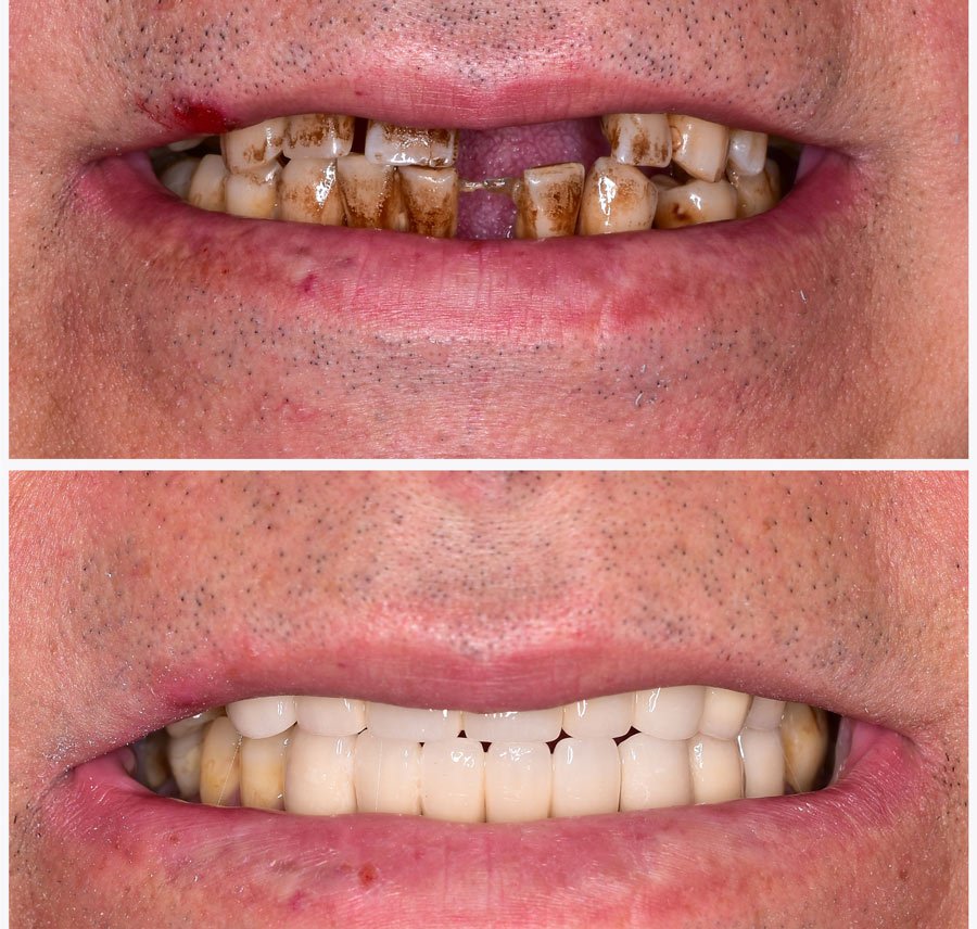 Porcelain crown result shade-matched to the patient's natural teeth in Istanbul