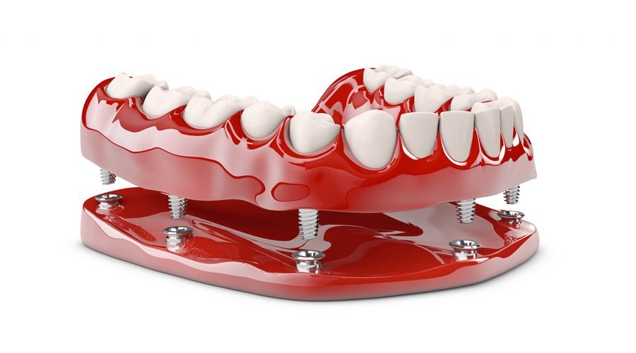 All-on-6 Dental Implants