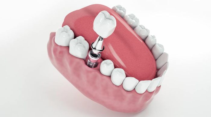 Immediate Implant Placement