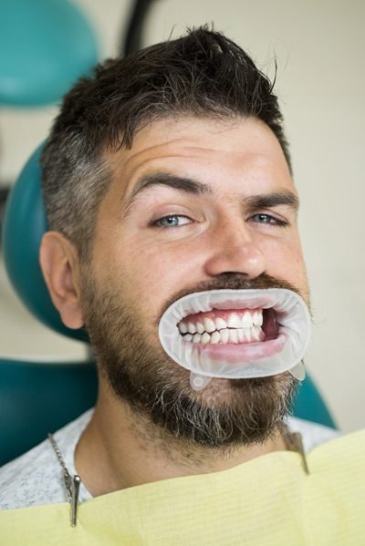 low cost dental implants