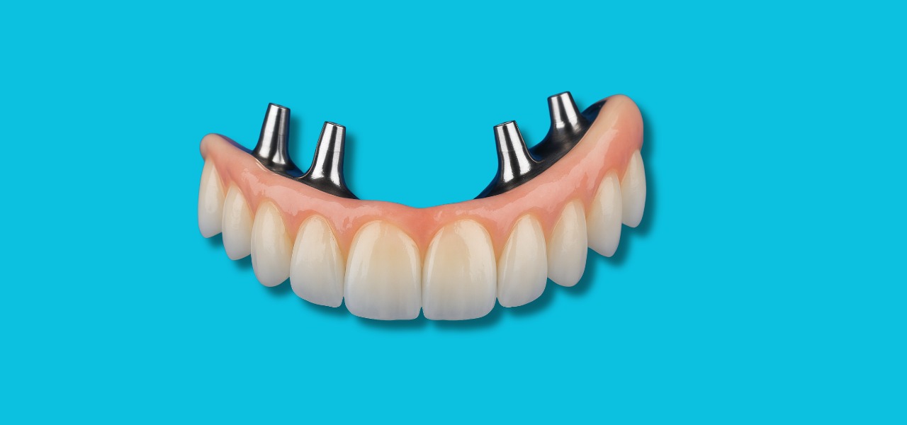 All-on-4 Implants