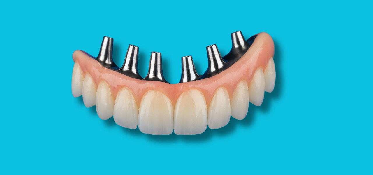 All-on-6 Implants