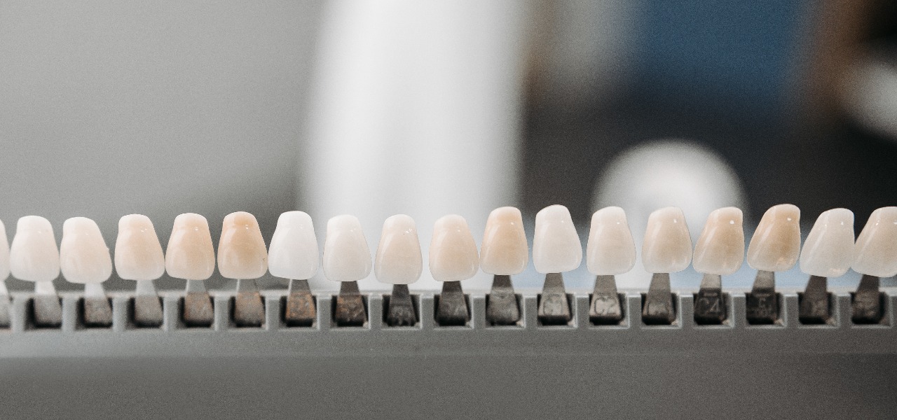 E-max Veneers