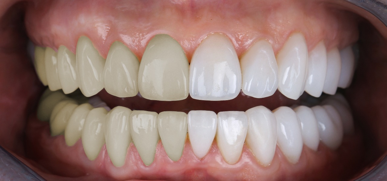 Gum contouring