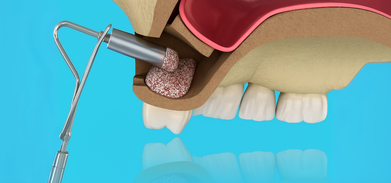 Sinus Lift-turkey
