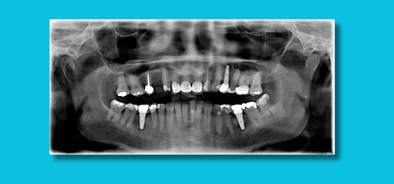 The Dental Implant Procedure