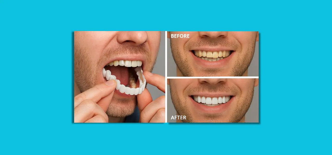 A person using snap-on veneers