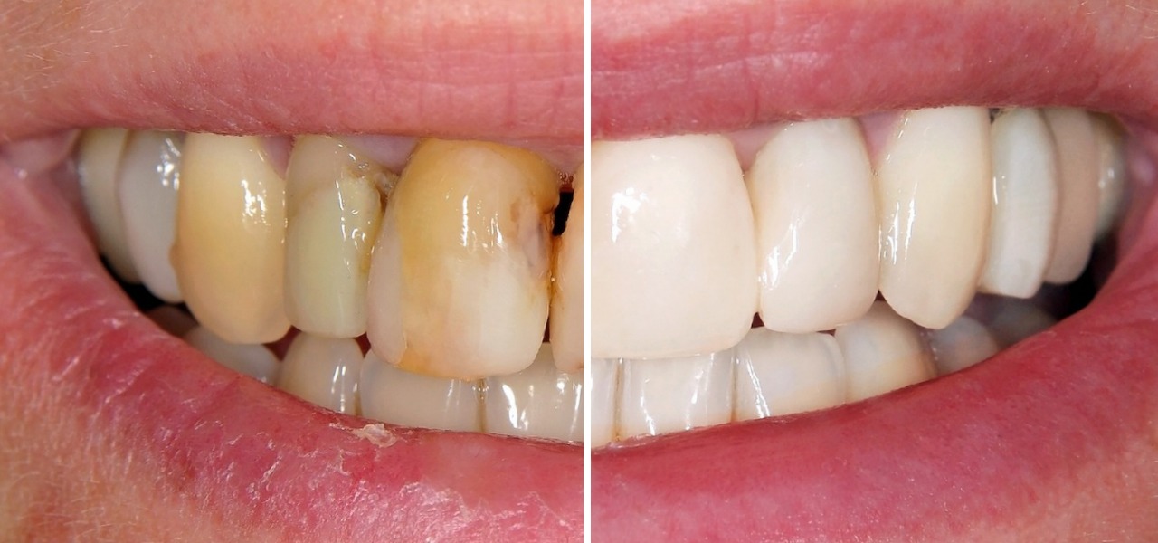 turkey teeth befor&after