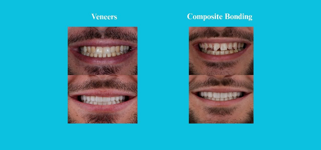 Bonding vs veneers pictures