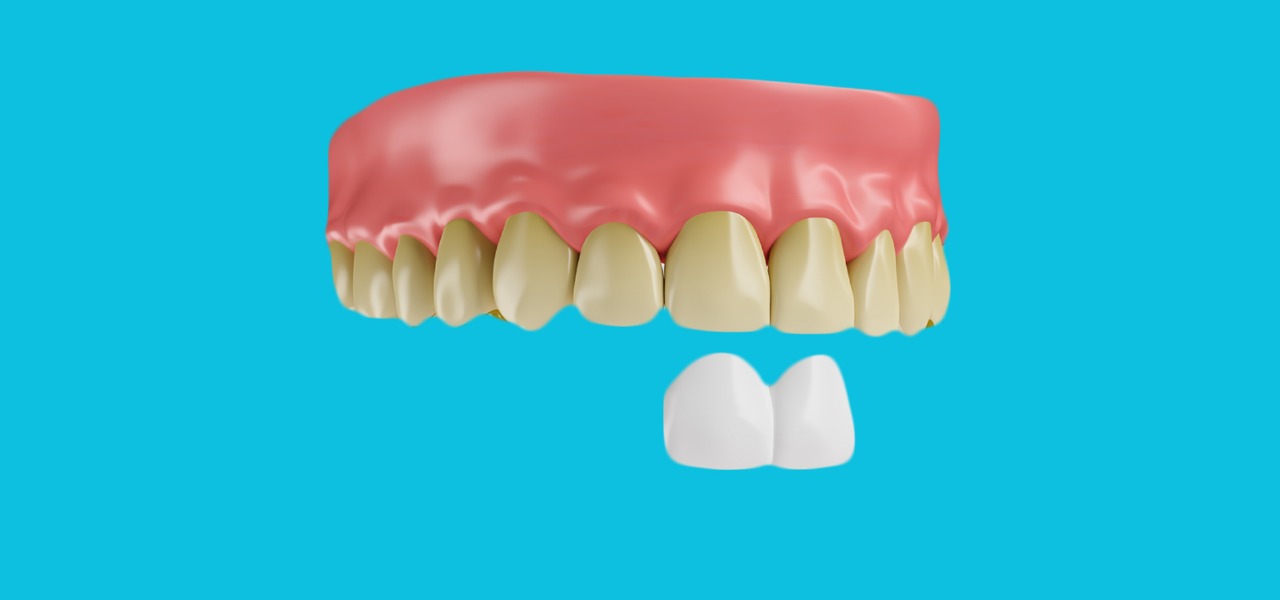 Dental Veneers 2025