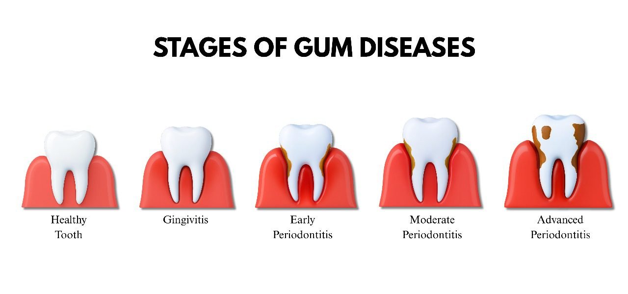 Gingivitis and Periodontitis
