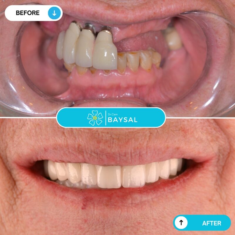 Turkey teeth implants