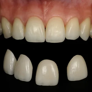 dental veneers-turkey