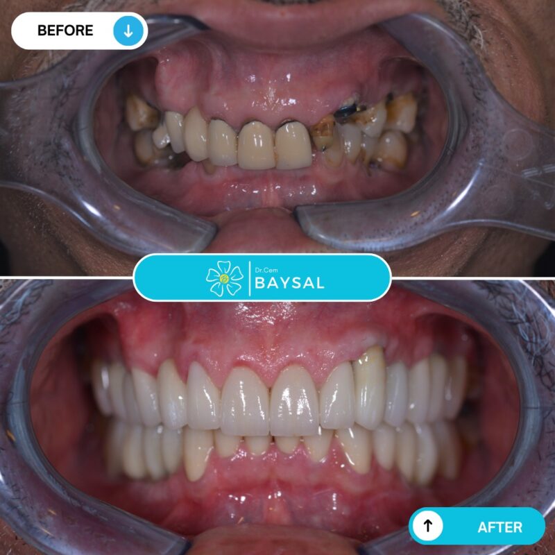 turkey teeth before and after 2025