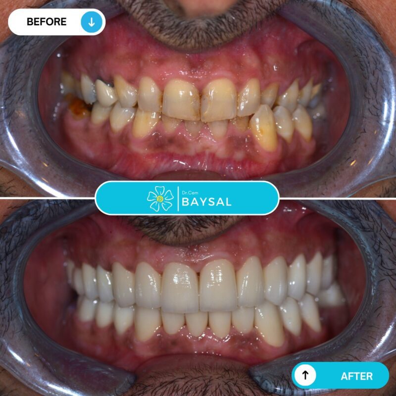 veneers turkey teeth 2026