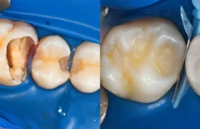 Pain After a Tooth Filling